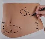 Tummy Tuck in Dubai
