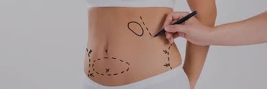 Tummy Tuck in Dubai